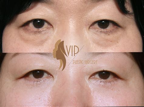 Lower eyelids surgery, also known as eye bag removal surgery reduces bagginess from lower ...