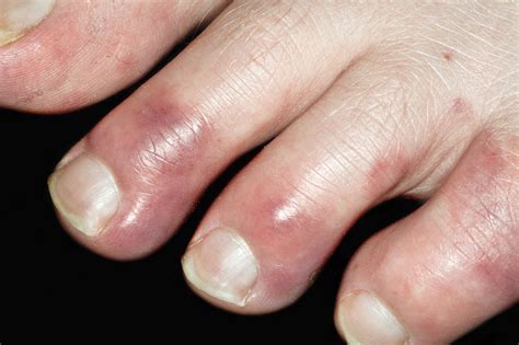 Chilblains -NHS - 金宝搏app