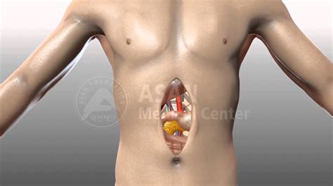 Open abdominal surgery - YouTube