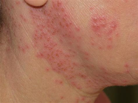 Treatment For Herpes Simplex On Face - Tratament