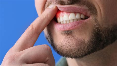 Gum Disease: Causes, Symptoms, and Prevention - Dr. Elston Wong Dentistry