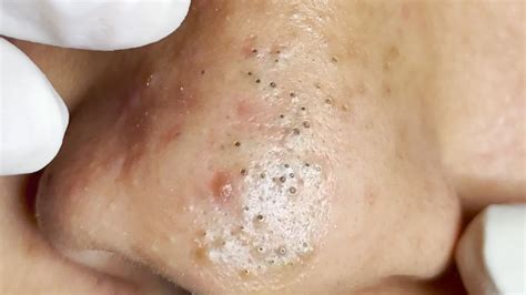 Large Blackheads On Nose