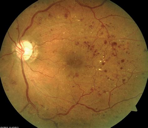 Could Selfie Fundus Imaging Boost Diabetic Retinopathy Screening?