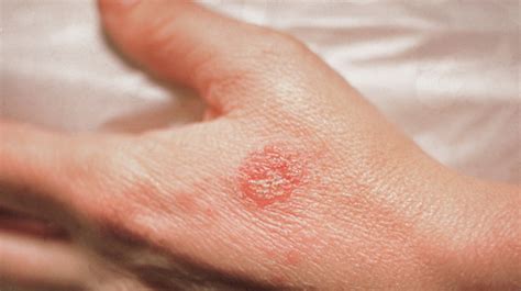 Nummular Eczema: Pictures, Treatment, and More