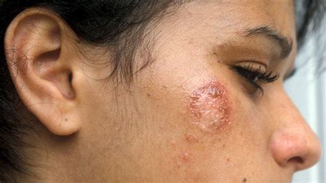 Impetigo Complications and Prevention Tips | Christ Memorial