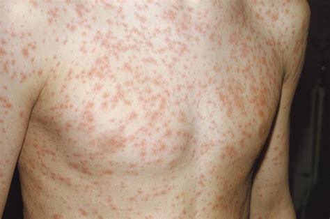 Measles Rash – Symptoms, Causes, Treatment