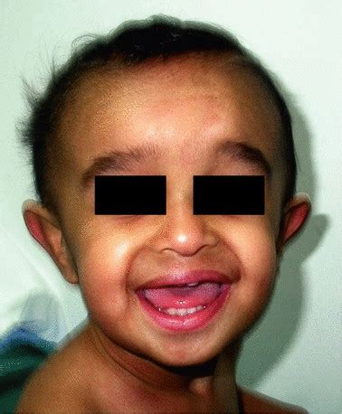 Dysmorphic facial features (patient 3). | Download Scientific Diagram