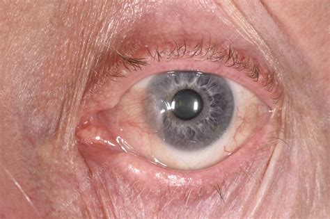 Pterygium eye disorder - Stock Image - C047/2923 - Science Photo Library