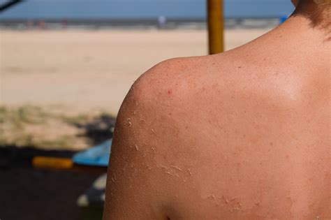 Have Water Blisters From Sunburn? Here Is Everything You