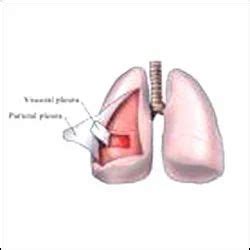 Diseases Treatment: Pleurisy Treatment