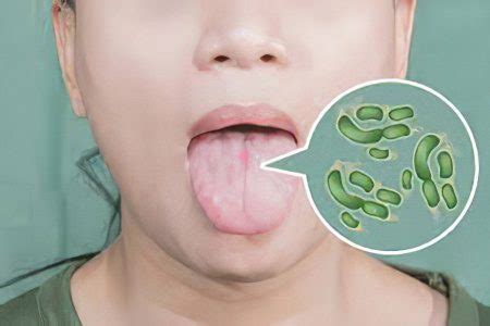 Glossitis: types, symptoms and treatment – Healthy Food Near Me