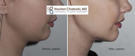 Chin Liposuction to improve a Double Chin