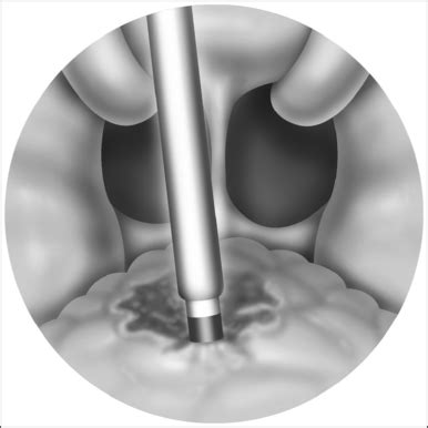 Current techniques of adenoidectomy | Pocket Dentistry