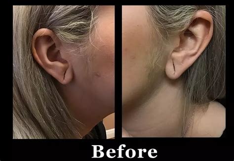 Ear Lobe Hole Repair | Svelte Medical Weight Loss