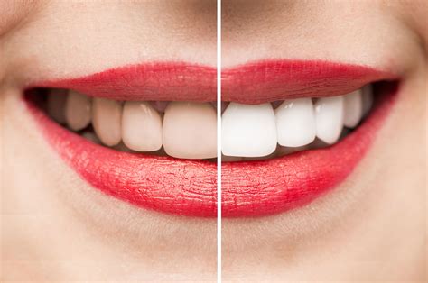 Teeth Whitening In The House: Exactly How To Obtain Your Teeth ...