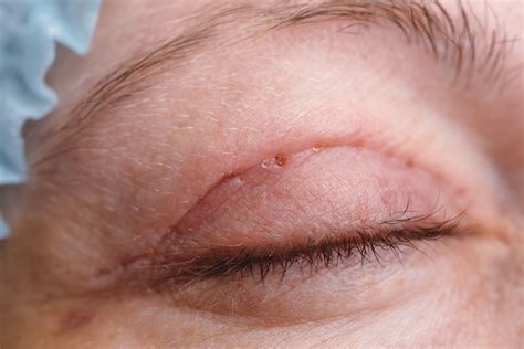 Upper Blepharoplasty Scars