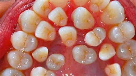 Multiple Hyperdontia