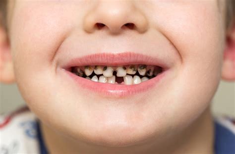 Why does my 4-year-old have so many cavities? | News | Dentagama