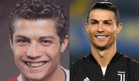 Ronaldo Teeth Before After