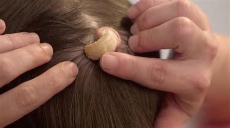 Dr. Pimple Popper treated a woman with a painful 'horn' growing on the ...