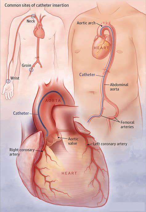 Cardiac Catheterization Procedure - The Steps, Duration, Heart Cath Risks