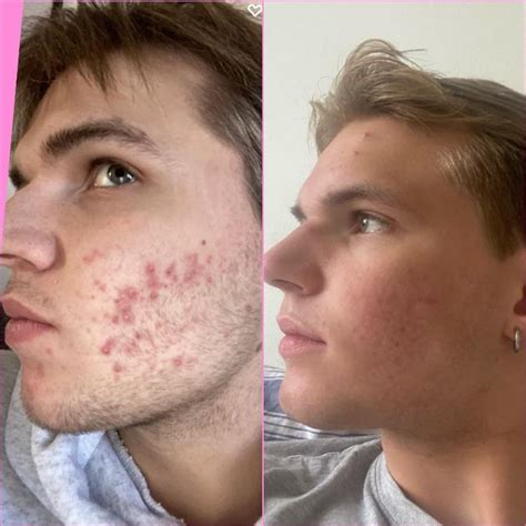 BEFORE after : r/Accutane