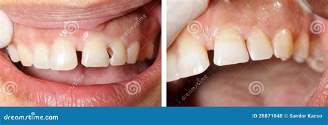 Dental filling treatment stock photo. Image of dentistry - 28871048