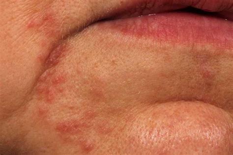 What Causes A Red Rash Around Your Lips | Allergy Trigger