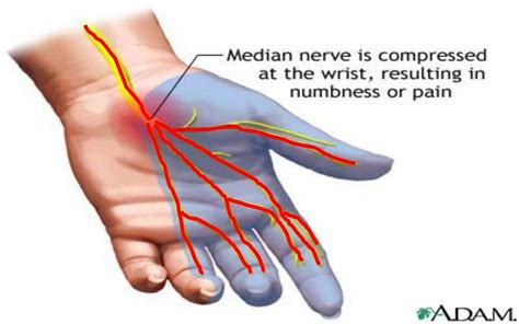 Median nerve injuries