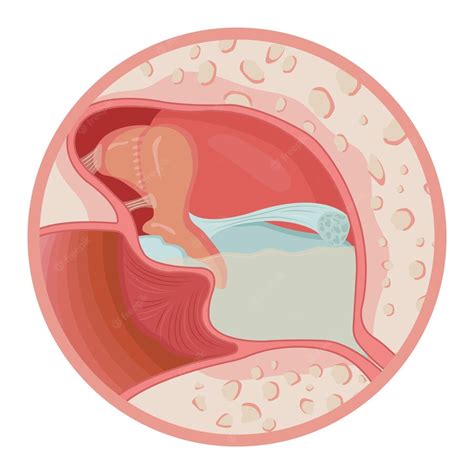 Premium Vector | Ear infection with fluids vector illustration