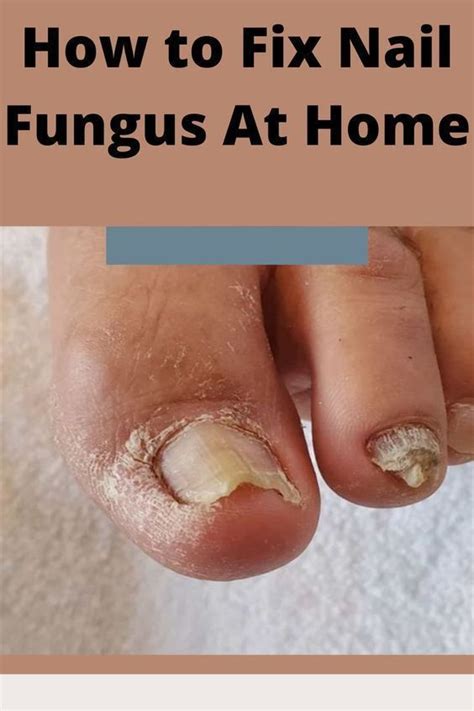 Nail Polish Recipe To Kill Fungus Naturally instantly.THIS is going to ...