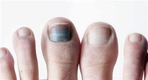 A Black Spot Under The Toenail: What Is It? - Feet First Clinic