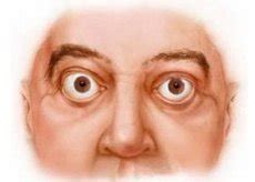 Exophthalmos: causes, symptoms, diagnosis, treatment