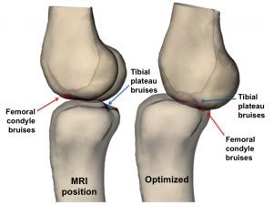 Scientists Solve Decades-Old Debate on ACL Tear | Duke Health Referring Physicians