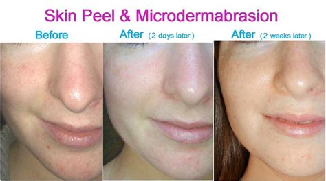 Glycolic Peel vs Microdermabrasion: Which Works Best?