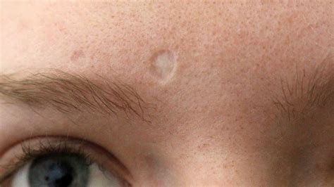 Chickenpox Scars Occur In 18% Of Infections: Expert Shares Causes ...