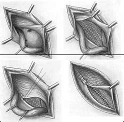 Types of Hernia Mesh – Beverly Hills Hernia Center