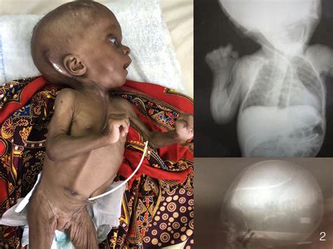 Failed ventriculoperitoneal shunt as treatment of infantile ...