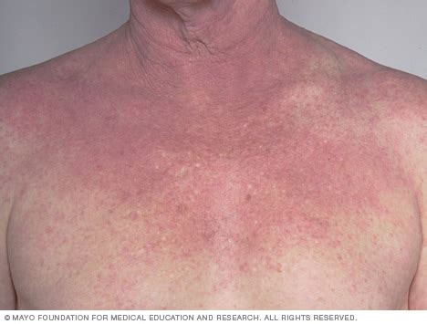 [39+] Mild Eczema Bumps On Face