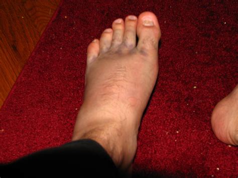 24 Hours After Fall | Left foot broken after a 12 foot fall … | Flickr