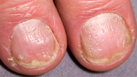 Pitted Fingernails Vitamin Deficiency - Nail Ftempo