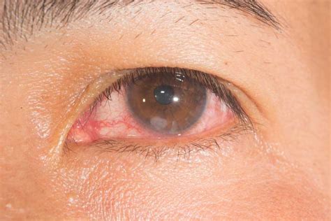 What is a Corneal Ulcer? :: Eye Health Central