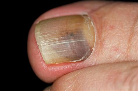 Infected Toe