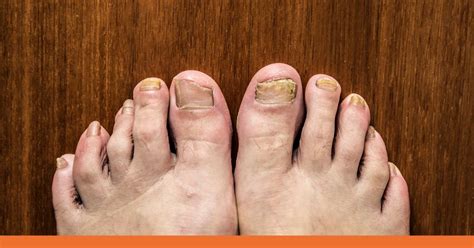 When to Seek Urgent Care for Toenail Injuries in Fairfield, CT