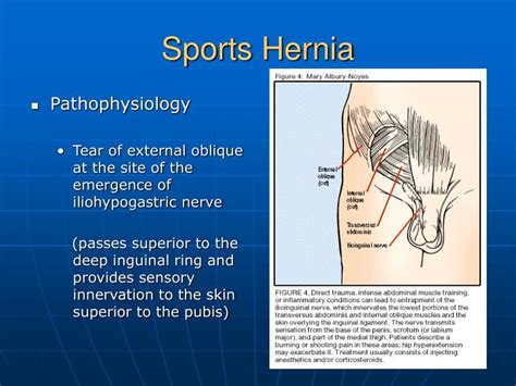 PPT - Sports Hernia PowerPoint Presentation - ID:5632534