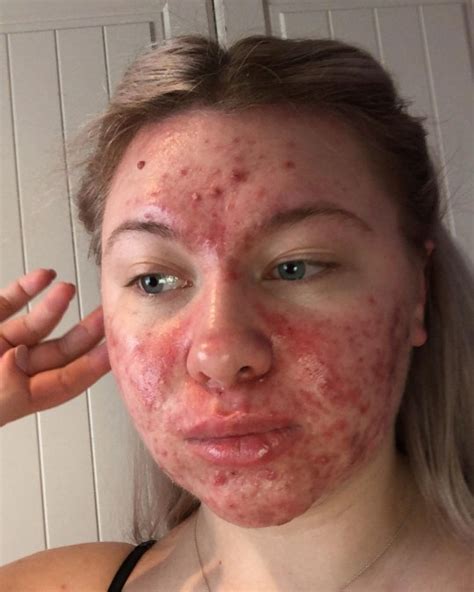 Woman with cystic acne finally feels comfortable going out without makeup | Metro News
