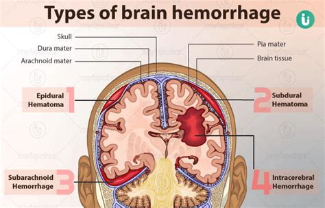 Brain Hemorrhage: symptoms, causes, treatment, medicine, prevention ...