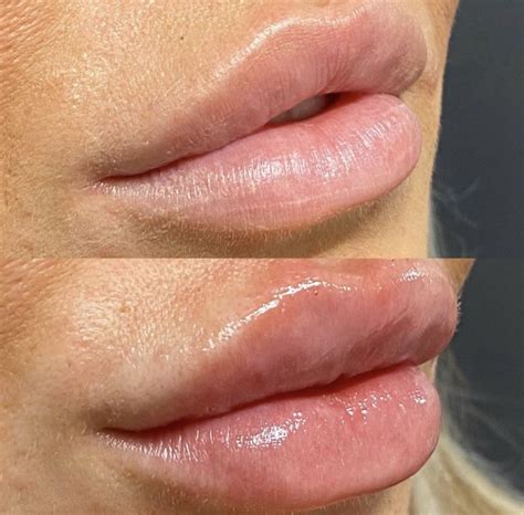 Lip filler - chessserre