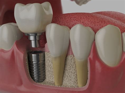 Dental Implant, Abutment and Crown - Dental Implant & Emergency Care - 1699 Dental Implant ...