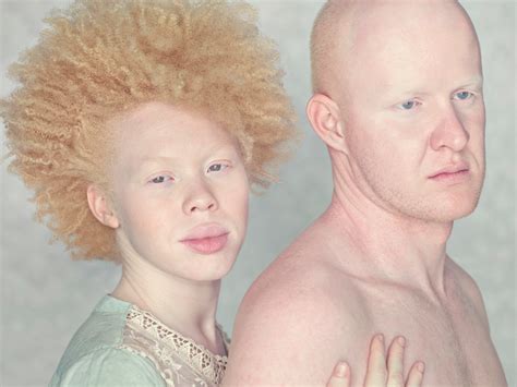 attractive albinos - Google Search | Albino, Baby face, Black history